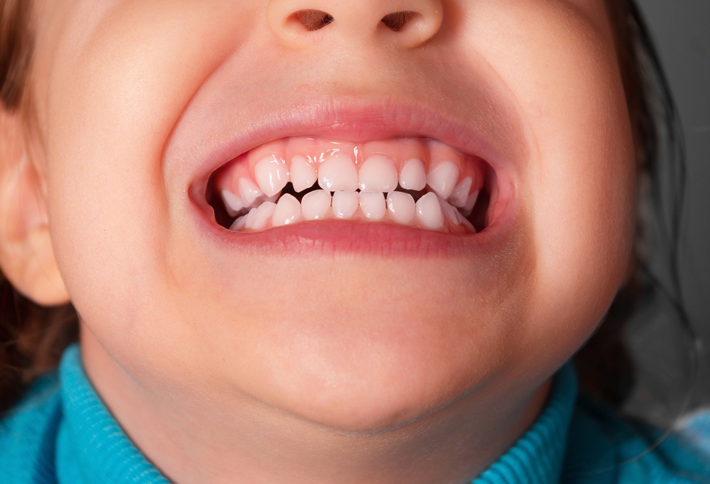 Zirconia Crown