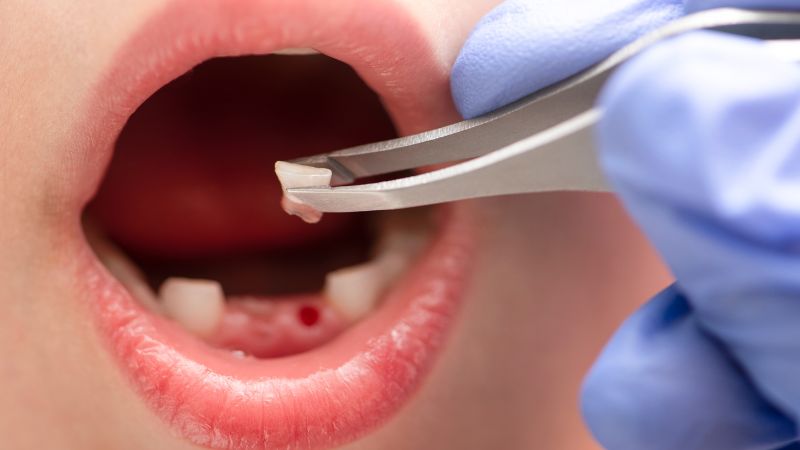 Tooth Extraction